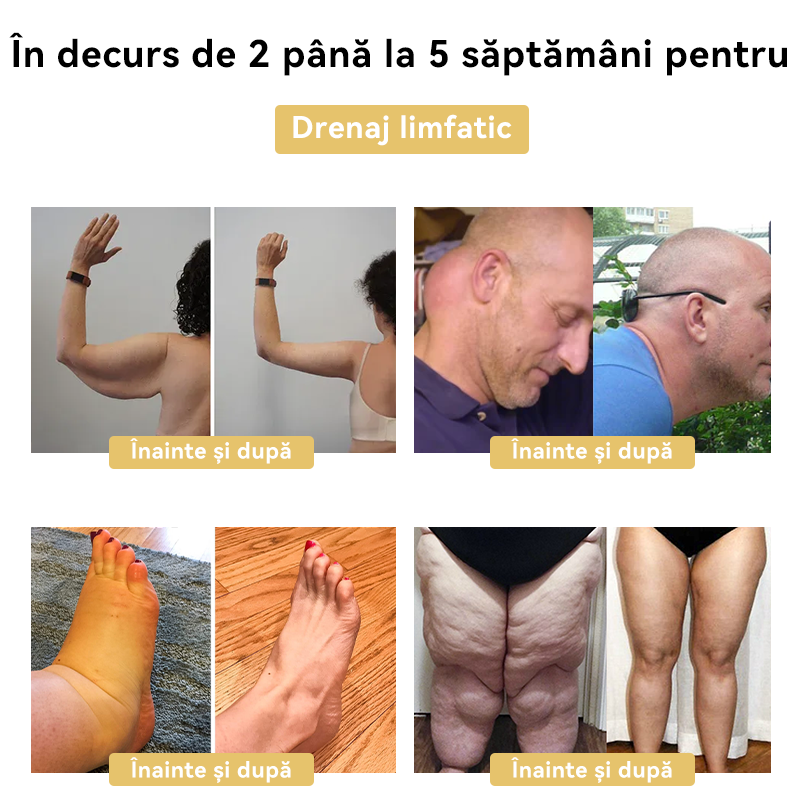 🧚🏻‍♂️𝑭𝑹𝑶𝑷𝑼𝑵™ Venin Albine Cremă de Slăbit⭐(Pentru toate problemele de limfă și obezitate)