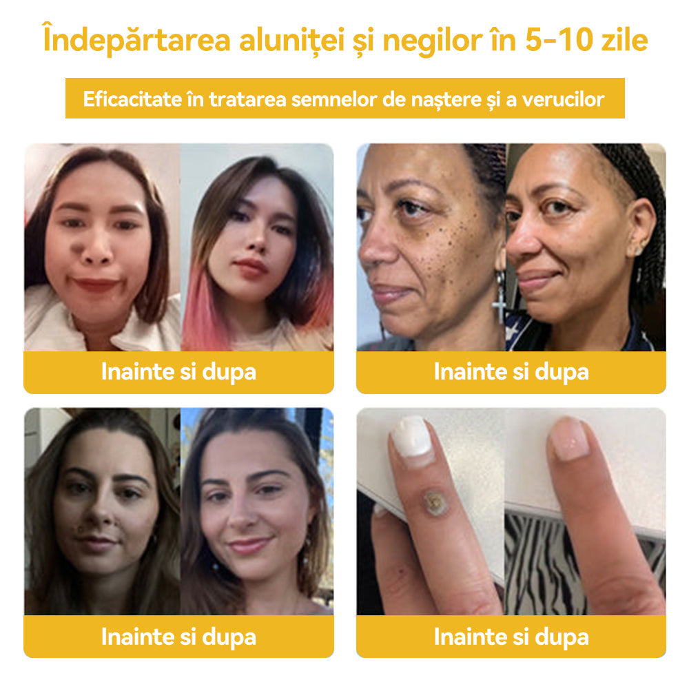🥝𝑺𝒑𝒛𝒗™ 𝑽𝒆𝒏𝒊𝒏 𝒅𝒆 𝒂𝒍𝒃𝒊𝒏𝒆 𝑪𝒓𝒆𝒎ă 𝒅𝒆 𝒕𝒓𝒂𝒕𝒂𝒎𝒆𝒏𝒕 𝒑𝒆𝒏𝒕𝒓𝒖 𝒂𝒍𝒖𝒏𝒊ț𝒆 ș𝒊 𝒗𝒆𝒓𝒖𝒄𝒊 ⚡⚡(🧑‍⚕️𝑹𝒆𝒄𝒐𝒎𝒂𝒏𝒅𝒂𝒓𝒆𝒂 𝒅𝒆𝒓𝒎𝒂𝒕𝒐𝒍𝒐𝒈𝒖𝒍𝒖𝒊 𝒔𝒑𝒆𝒄𝒊𝒂𝒍𝒊𝒔𝒕🔥🔥𝑼𝒍𝒕𝒊𝒎𝒂 𝒛𝒊 𝒅𝒆 𝒑𝒓𝒐𝒎𝒐𝒗𝒂𝒓𝒆𝒍 80% 𝒐𝒇𝒇)