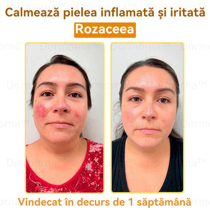 Oficial al Clinicii Mayo:🦙 𝐒𝐩𝐳𝐯™ 𝐁𝐎𝐓𝐎𝐗 𝐕𝐞𝐧𝐢𝐧 𝐝𝐞 𝐚𝐥𝐛𝐢𝐧𝐞 𝐂𝐫𝐞𝐦ă 𝐝𝐞 𝐭𝐫𝐚𝐭𝐚𝐫𝐞 𝐚 𝐩𝐢𝐞𝐥𝐢𝐢, Hidratare, repararea pielii, ton uniform, tratament pentru acnee și pete întunecate, îndepărtarea negilor și alunițelor, ameliorarea psoriazisului