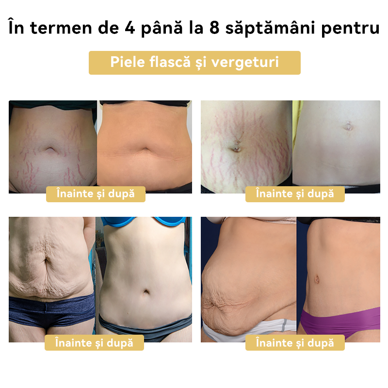 🧚🏻‍♂️𝑭𝑹𝑶𝑷𝑼𝑵™ Venin Albine Cremă de Slăbit⭐(Pentru toate problemele de limfă și obezitate)