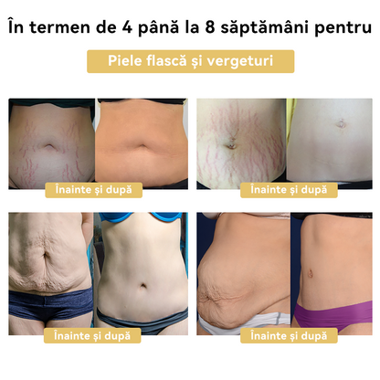 🧚🏻‍♂️𝑭𝑹𝑶𝑷𝑼𝑵™ Venin Albine Cremă de Slăbit⭐(Pentru toate problemele de limfă și obezitate)