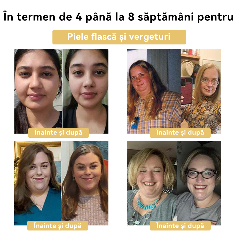 🧚🏻‍♂️𝑭𝑹𝑶𝑷𝑼𝑵™ Venin Albine Cremă de Slăbit⭐(Pentru toate problemele de limfă și obezitate)