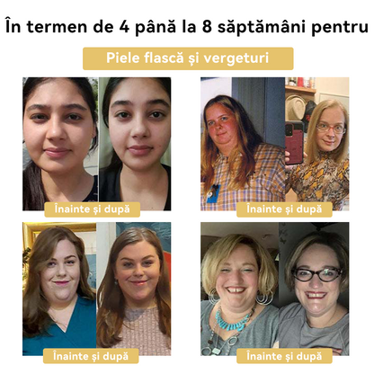 🧚🏻‍♂️𝑭𝑹𝑶𝑷𝑼𝑵™ Venin Albine Cremă de Slăbit⭐(Pentru toate problemele de limfă și obezitate)